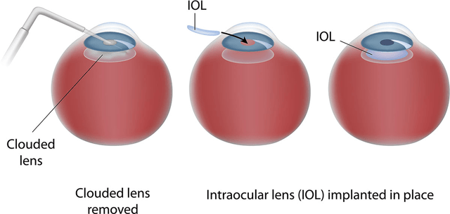 intraocular lens