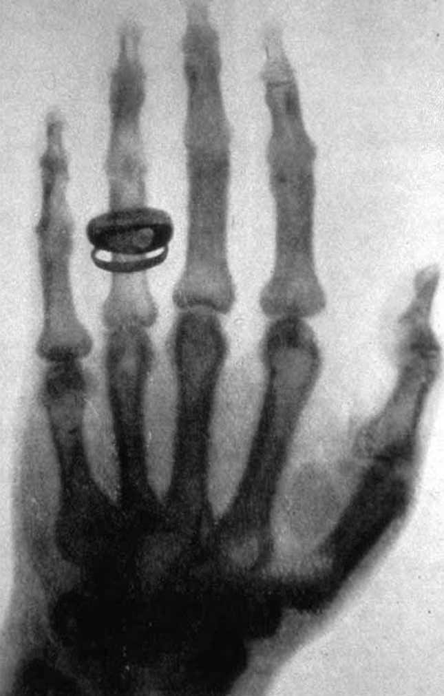 An early X-ray image of a human hand taken by Wilhelm Röntgen.