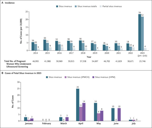 Panel A shows the incidence of fetal situs inversus that had been diagnosed at two obstetrical centers from January 2014 through July 2023. The numbers above the bars are the total case numbers by year. Incidence is reported as the number of cases per 10,000 pregnant women who underwent ultrasound screening. Panel B shows the number of fetal situs inversus cases that had been diagnosed at the International Peace Maternity and Child Health Hospital of China Welfare Institute (IPMCH), Shanghai, and the Hunan Provincial Maternal and Child Health Care Hospital (HPM), Changsha, from January 2023 through July 2023.