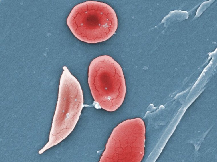 This digitally colorized scanning electron micrograph (SEM) revealed some of the comparative ultrastructural morphology between normal red blood cells (RBCs), and a sickle cell RBC (left) found in a blood specimen of an 18-year-old female patient with sickle cell anemia.