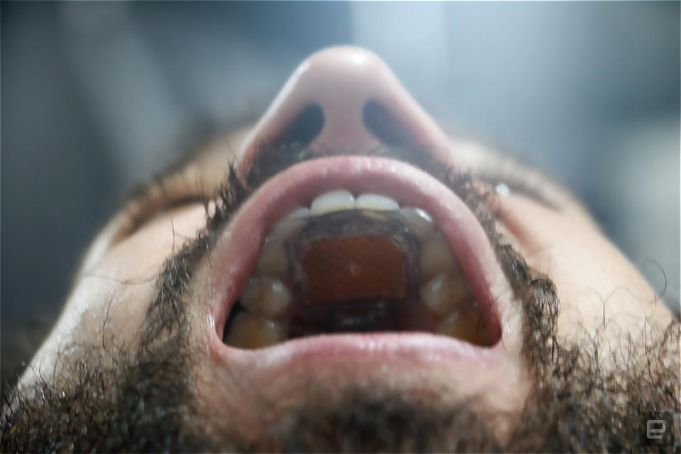 A down-up look at the MouthPad inside a person's mouth.