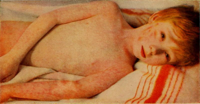 A child with measles.