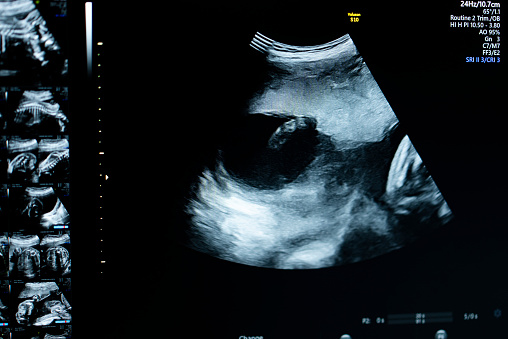 Ultrasound sonogram of fetus 22 week pregnant