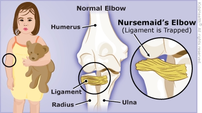 Cost of going to the emergency room and treating Nursemaid's Elbow