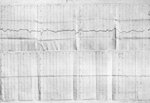 Two graphs, the upper one showing a fluctuating horizontal line and the other showing a horizontal line with very little variation.