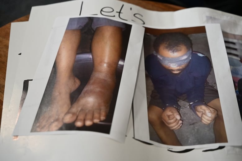 Photo of feet with one visibly inflamed next to photo of man with duct tape over eyes and in handcuffs