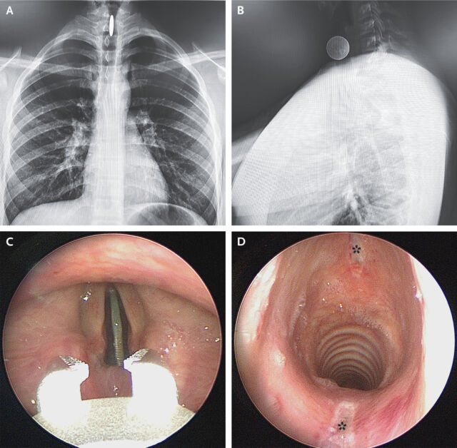  Radiographs of the chest (Panel A, postero- anterior view) and neck (Panel B, lateral view). Removal with optical forceps (Panel C and Video 1), and reinspection of ulceration (Panel D, asterisks)