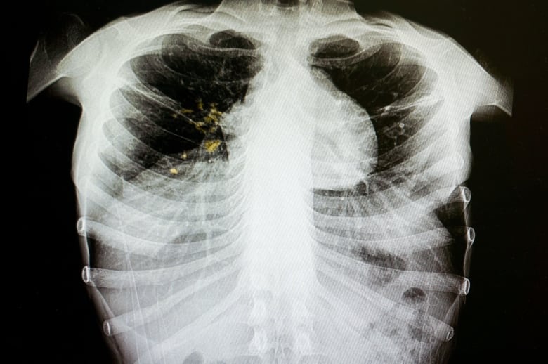 A x-ray shows tuberculosis in the lungs