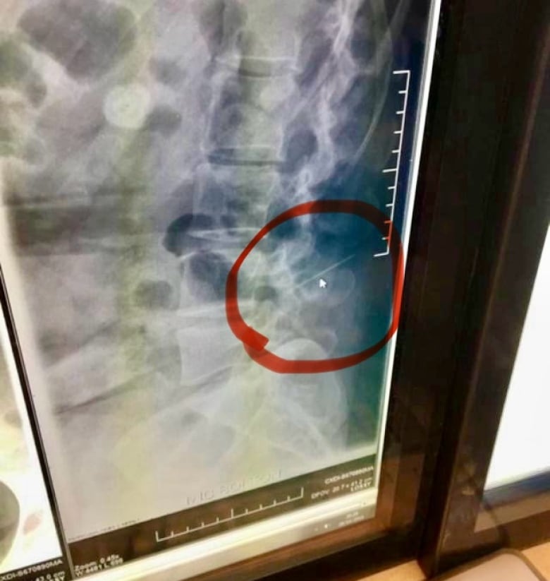 A brightly lit screen displays an x-ray image of a spine. A red circle draws attention to a small cursor that points to a long, straight line.